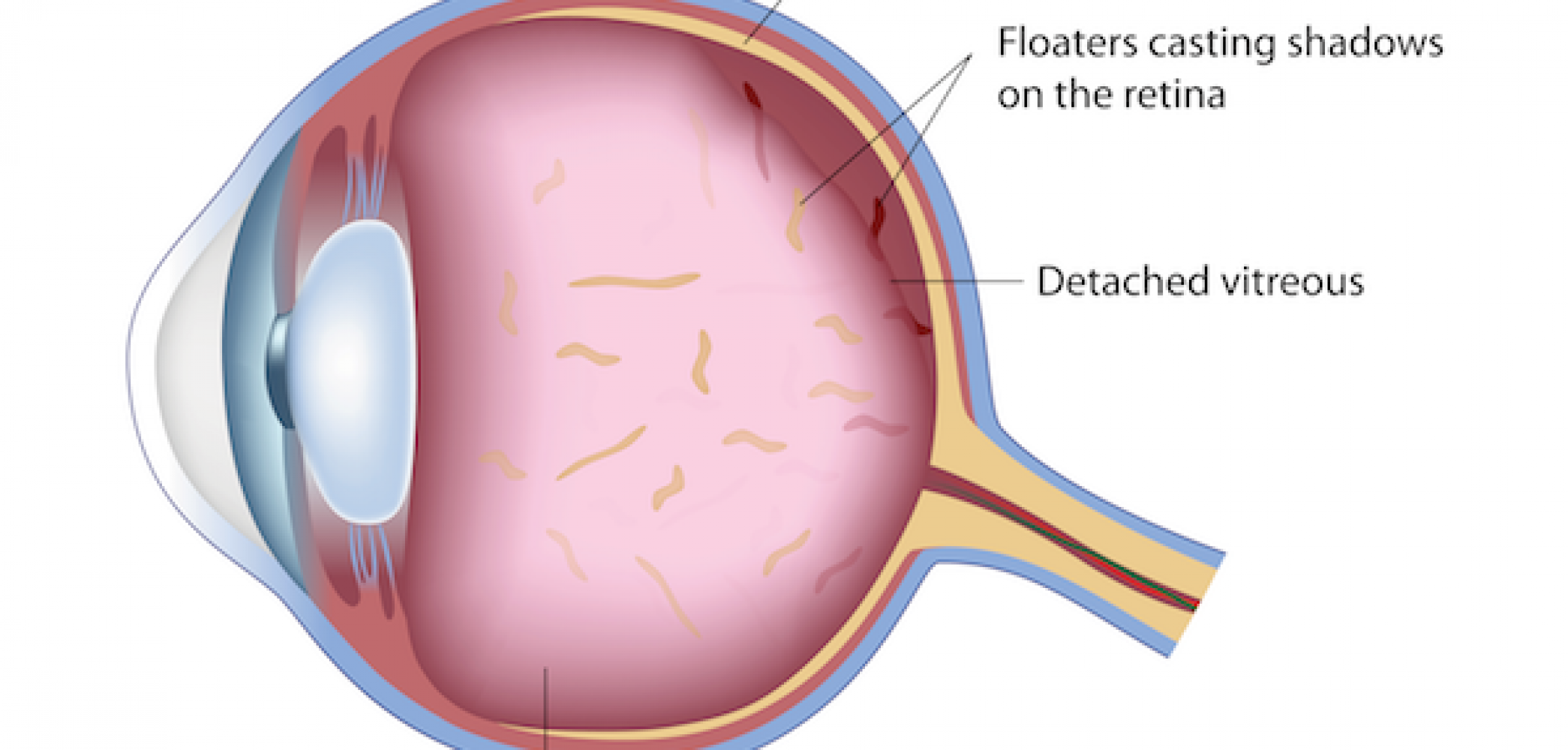 floaters-and-flashes-in-the-eyes-la-pine-eyecare-clinic