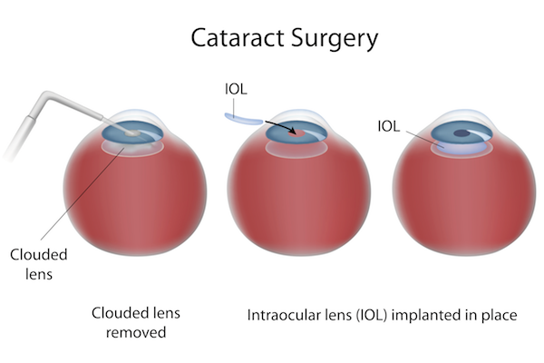 cataract-surgery-dp-copy