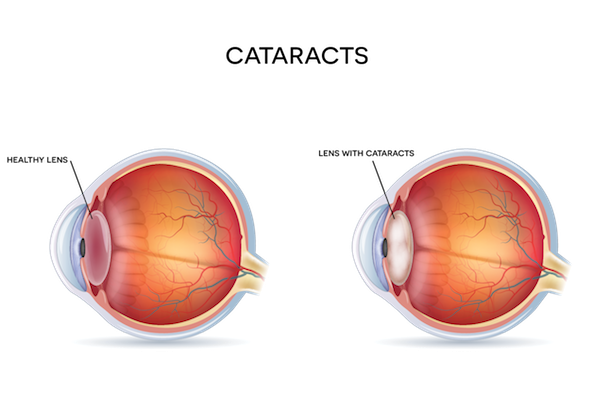 cataracts-general-lp-copy