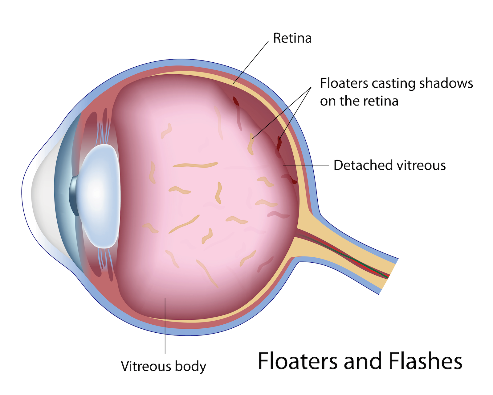 flashes-and-floaters-copy